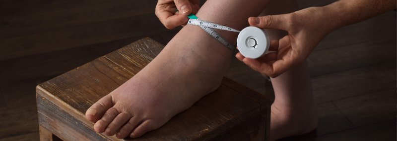 Swollen foot with person using measuring tape on it